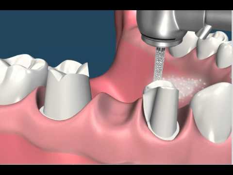 Preparacion para restauraciones libre de metal
